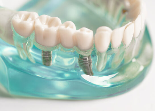 Le alternative alle protesi fisse: soluzioni innovative per il recupero dentale