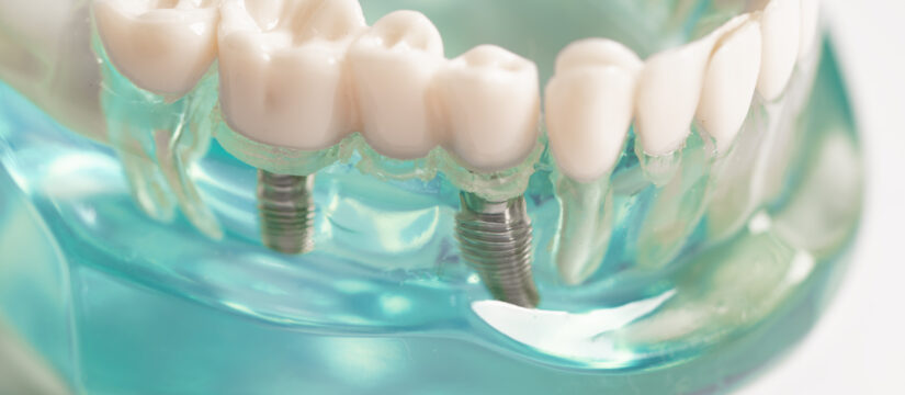 Le alternative alle protesi fisse: soluzioni innovative per il recupero dentale