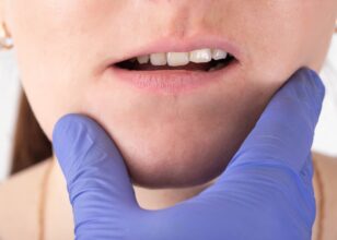 Malocclusioni: il trattamento ortodontico giusto per te a Chioggia